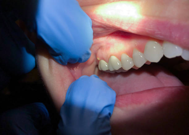 Best Broken or Chipped Tooth Repair in Plover, WI